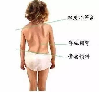 警惕！孩子的“小毛病”或是体态危机——濮阳油田总医院五一免费筛查守护成长(图3)